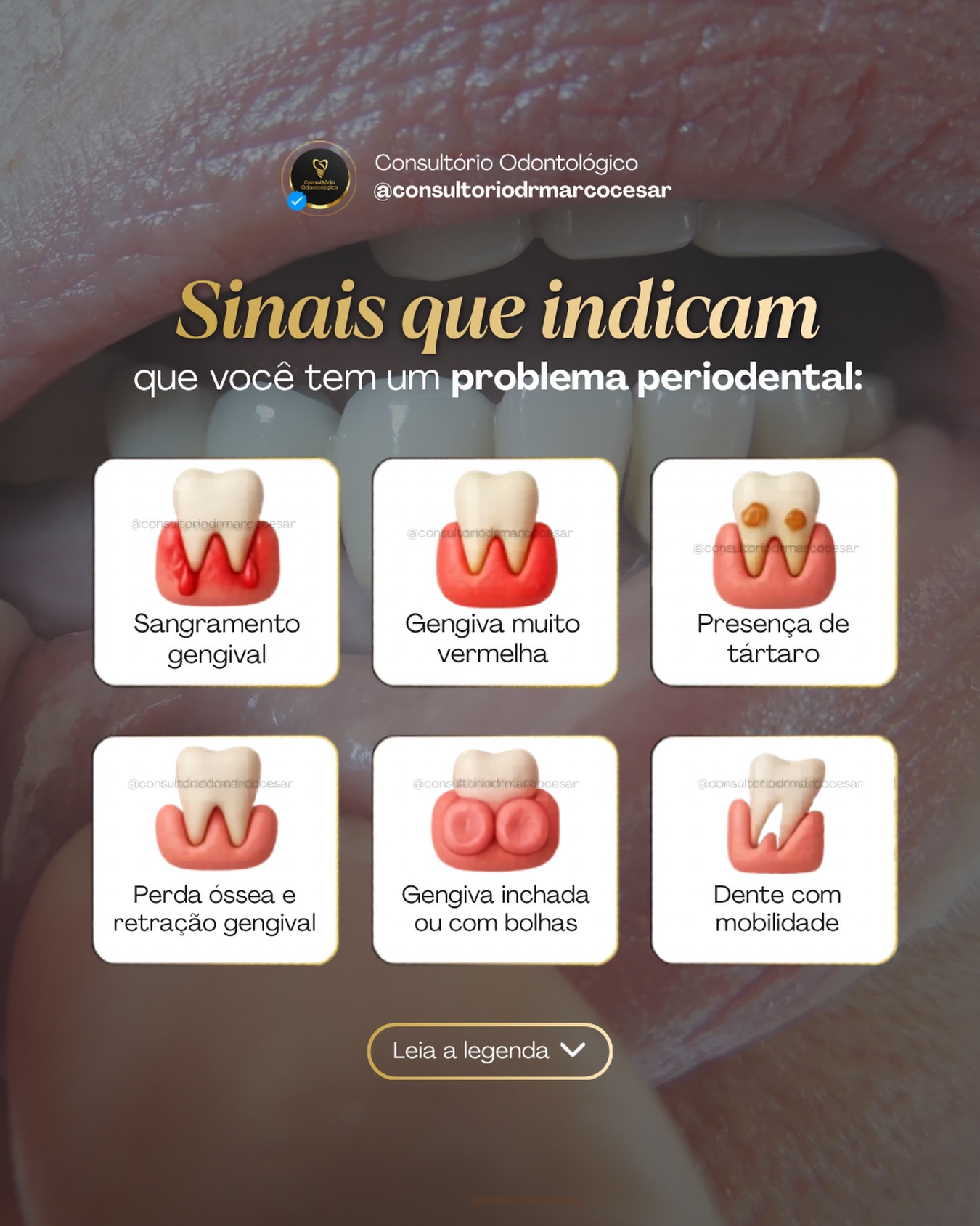 Postagem do Instagram sobre sinais de problema periodontal